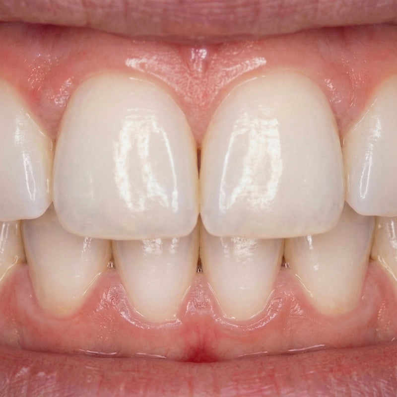 Before and after water flossing